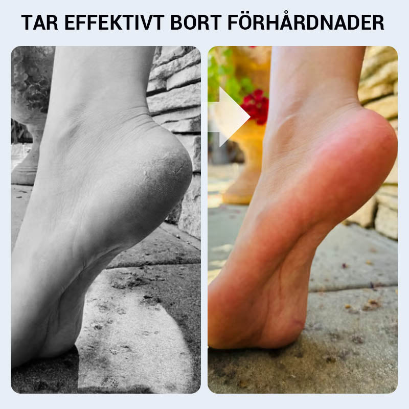 🔥 Indepărtarea manuală practică a calusului pentru picioare🦶🏻